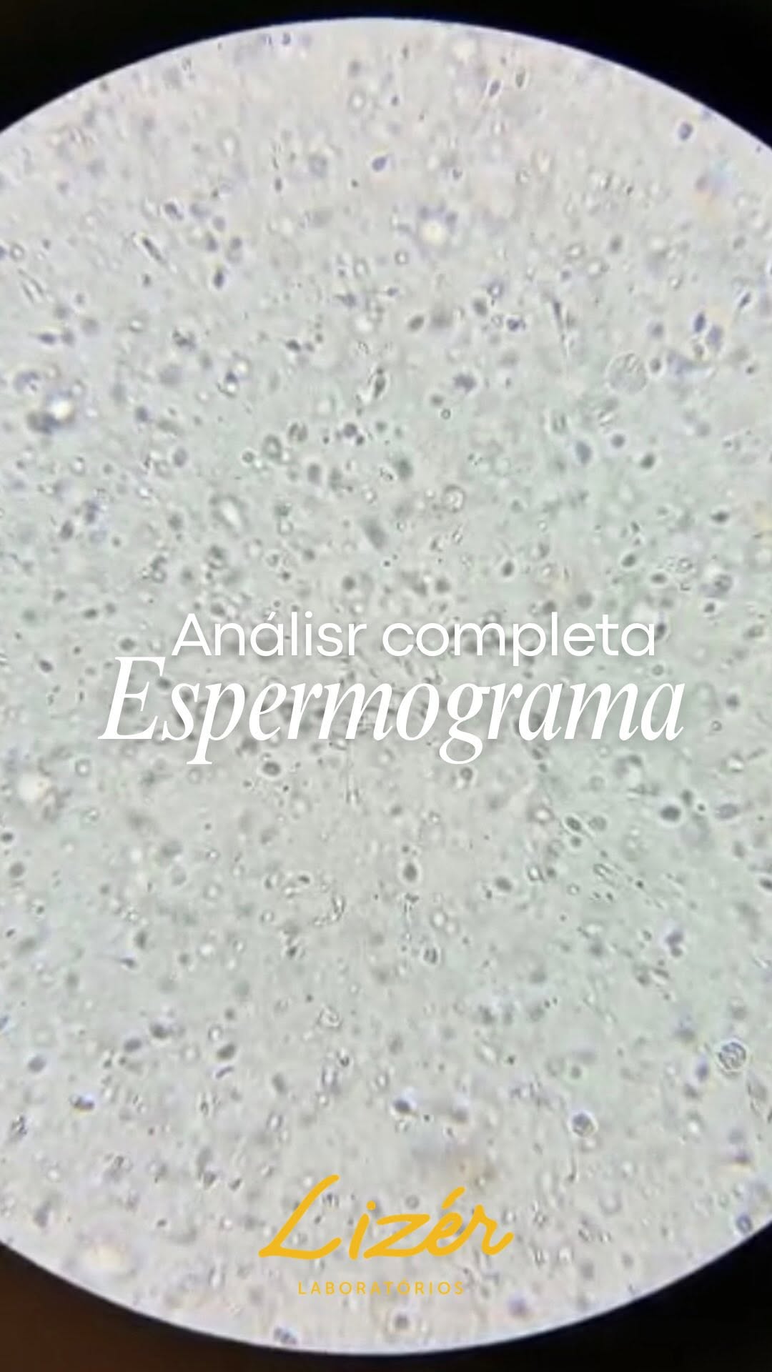 O espermograma é muito mais do que um exame para investigar fertilidade. Ele fornece informações importantes sobre a saúde reprodutiva masculina, avaliando a concentração, a motilidade e a morfologia dos espermatozoides.

Neste vídeo, mostramos a diferença entre um espermograma normal e um exame com alterações, além de explicar por que essa análise é fundamental para o diagnóstico, acompanhamento de tratamentos e confirmação do sucesso da vasectomia.

No Lizér Laboratórios, cada espermograma é realizado seguindo rigorosos padrões de qualidade, garantindo resultados precisos e confiáveis.

#lizerlaboratorios #espermograma #saudemasculina #fertilidade
